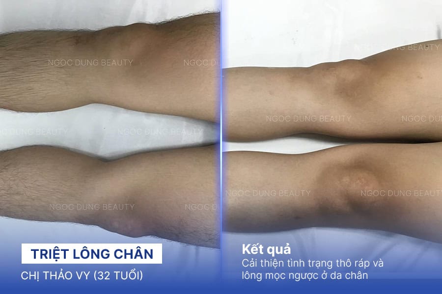 Kết quả triệt lông chân tại Ngọc Dung