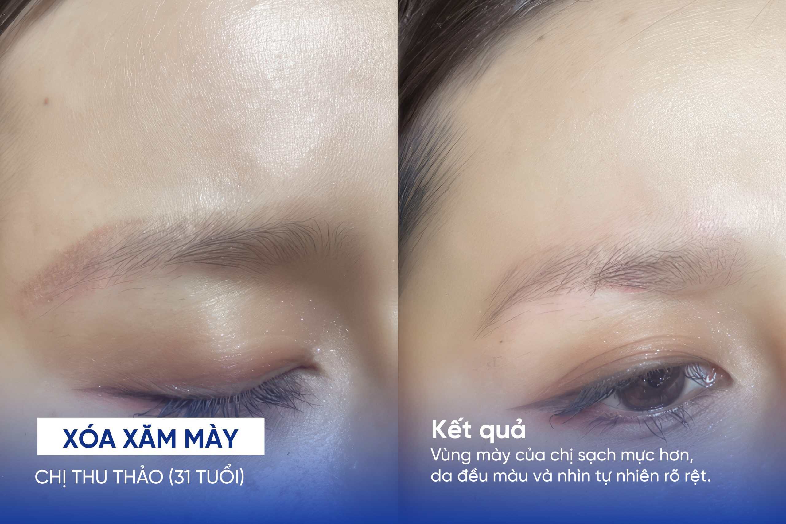 Xóa xăm chân mày có để lại sẹo không? Lợi ích và rủi ro 12 Kết quả xóa xăm mày của chị Thu Thảo