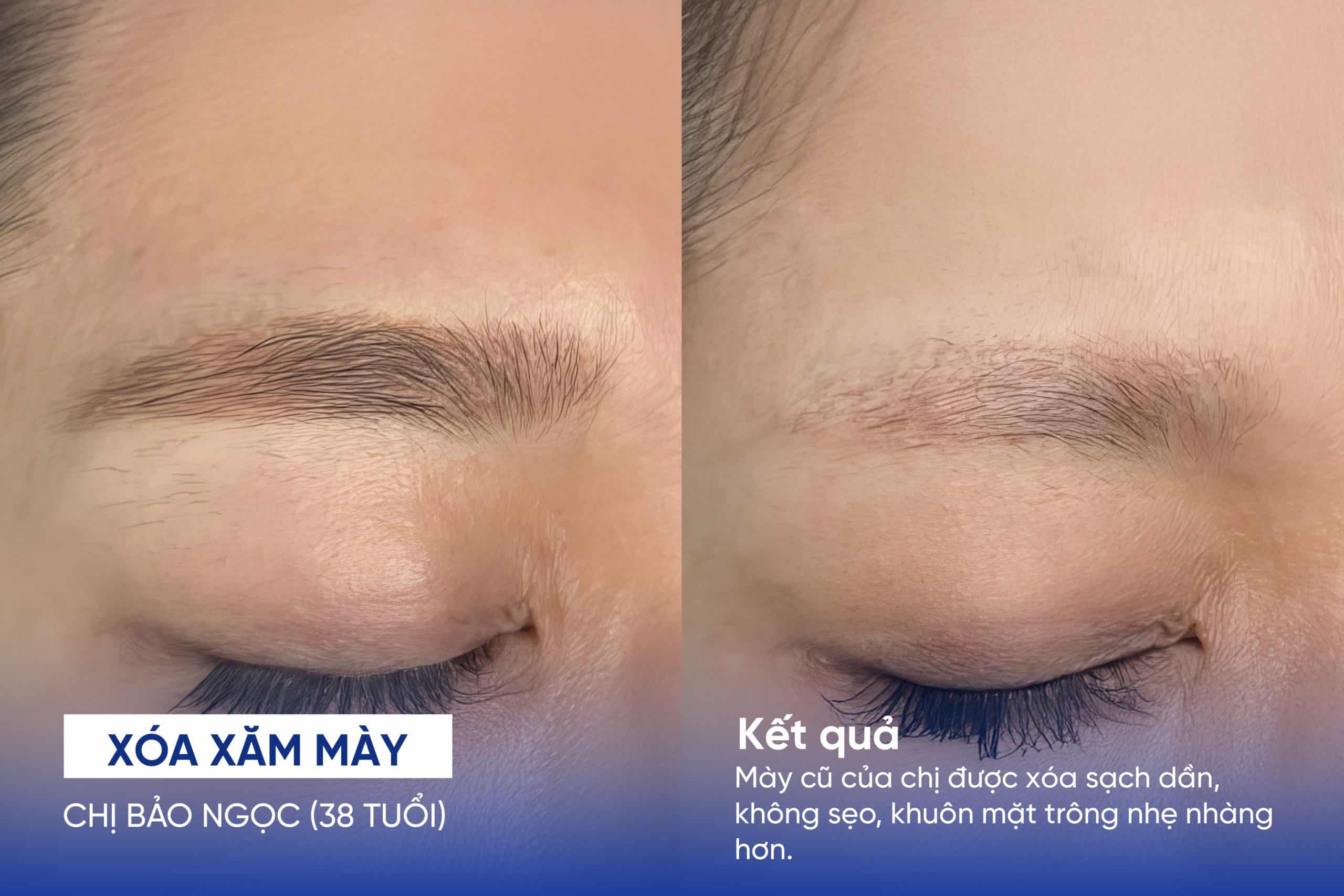 Xóa xăm chân mày có để lại sẹo không? Lợi ích và rủi ro 13 Kết quả xóa xăm mày của chị Bảo Ngọc