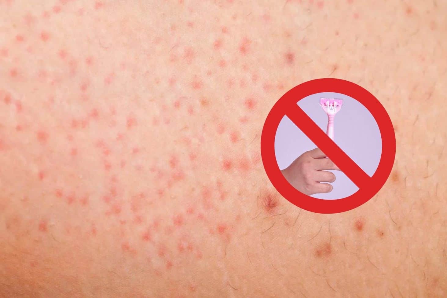 Không nên cạo lông mặt khi da đang bị mụn