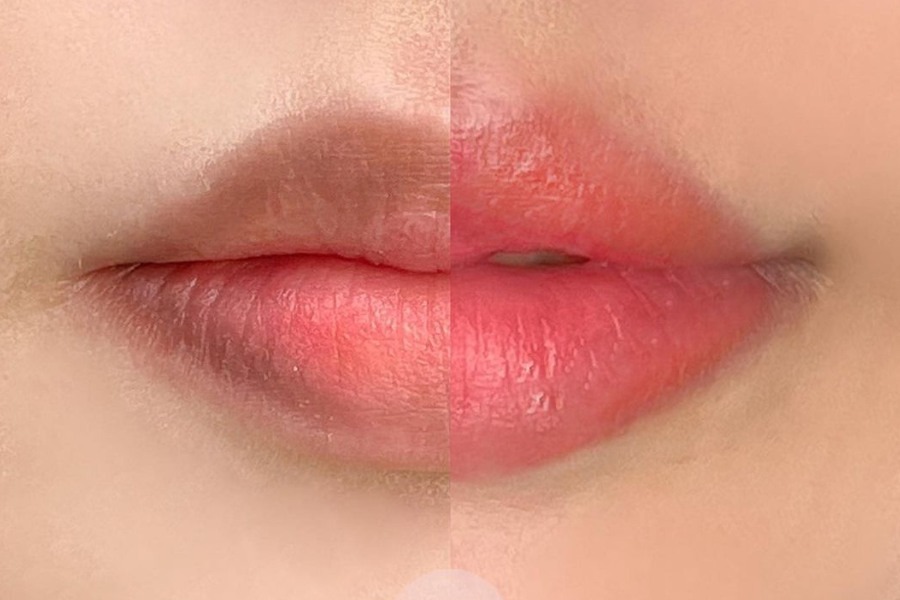 Khử thâm môi bao nhiêu tiền sẽ phụ thuộc vào việc lựa chọn cách dịch vụ khử thâm khắc nhau