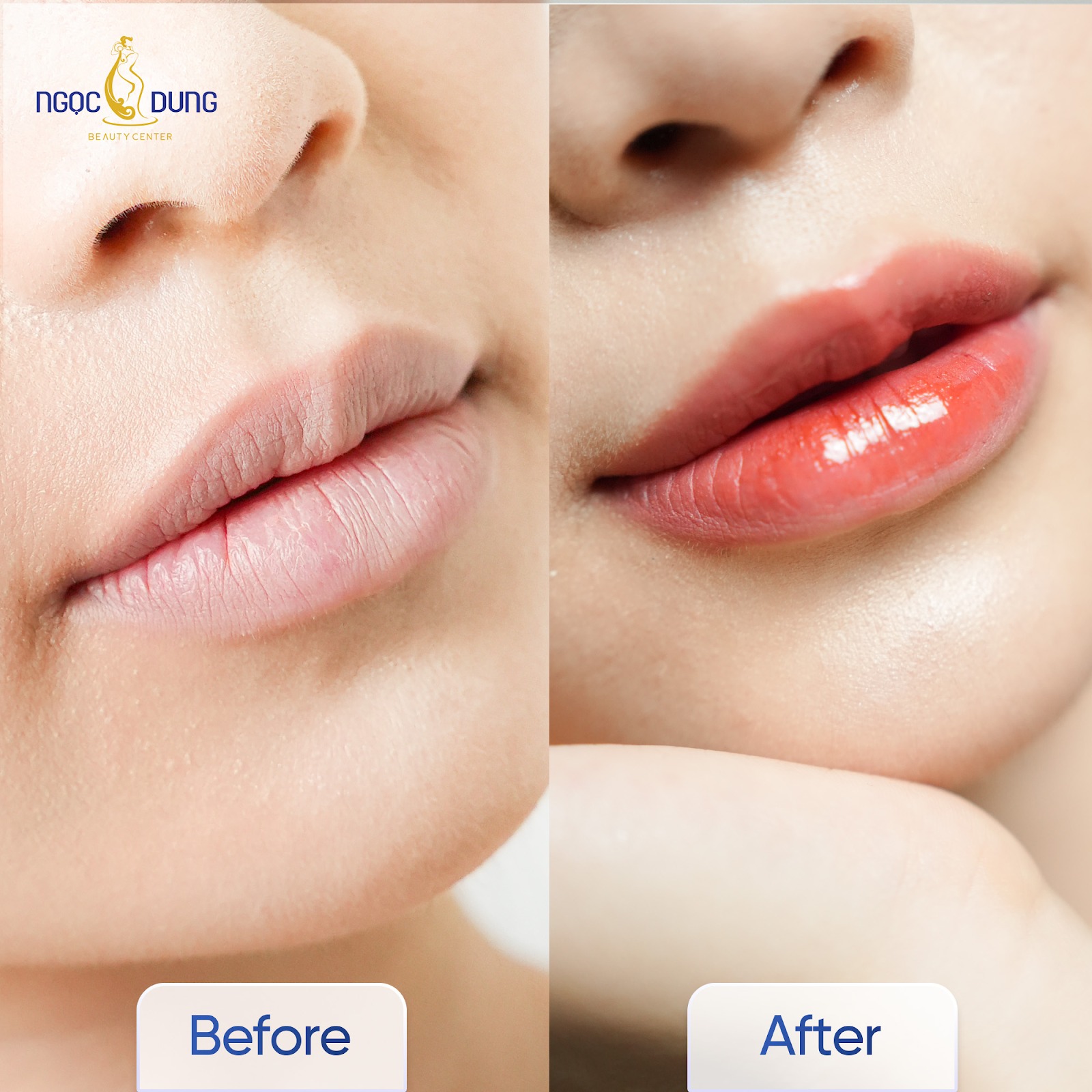Tùy vào tình trạng môi, bạn có thể lựa chọn các dịch vụ khử thâm phù hợp