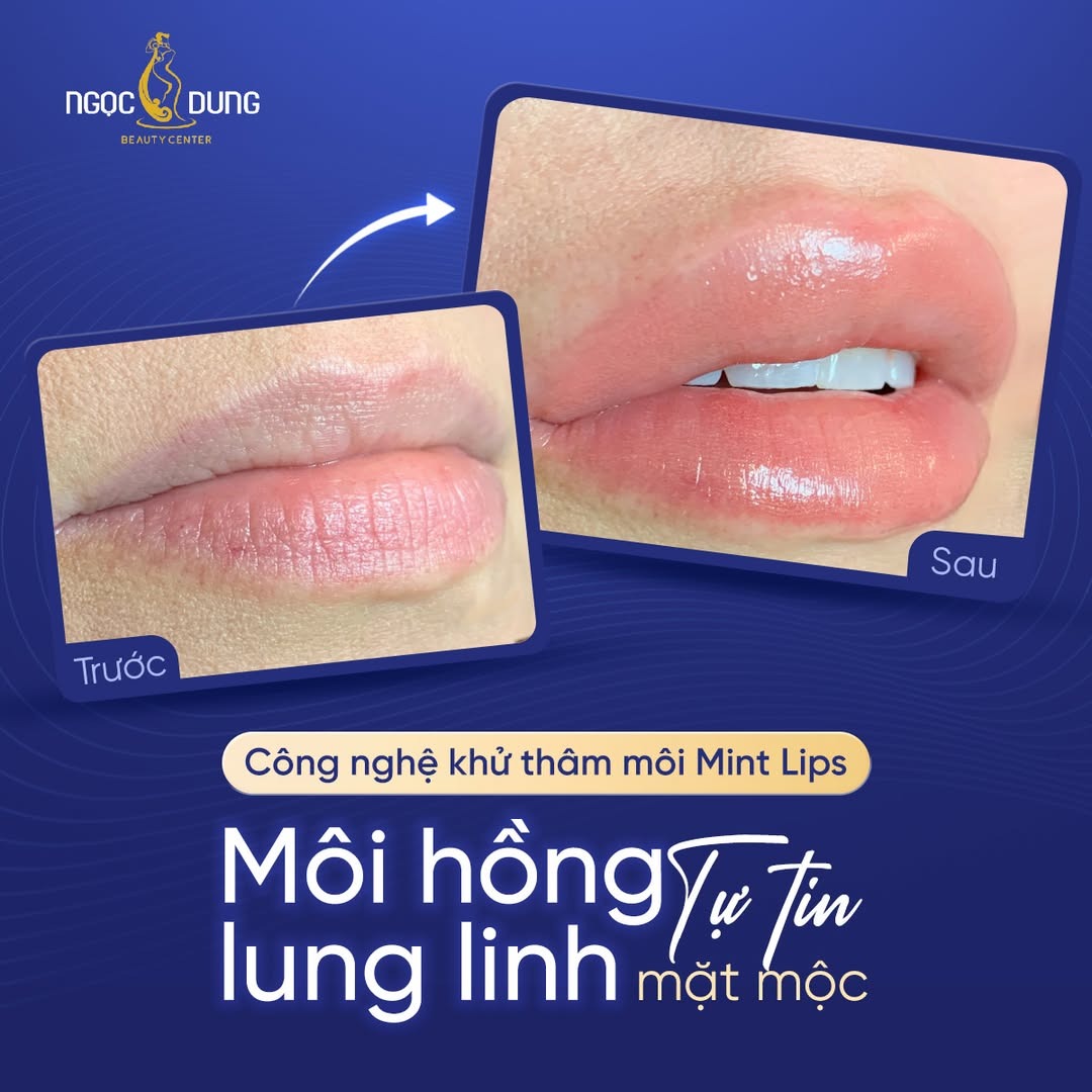 Công nghệ khử thâm môi Mint Lips tại Ngọc Dung được nhiều người lựa chọn