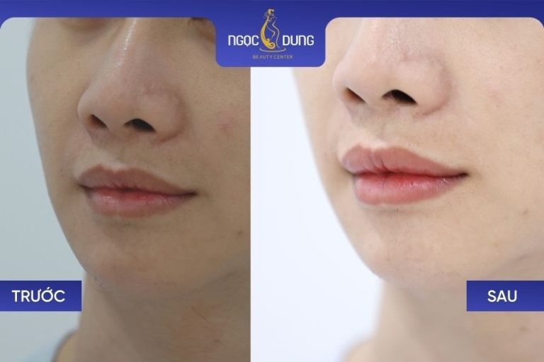 Sau khi phun môi để khử thâm, sắc môi được cải thiện rõ rệt