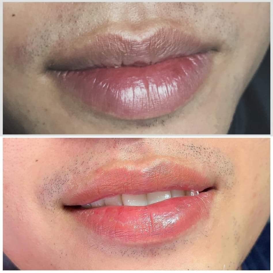 Sau khi khử thâm môi nam tại Thẩm mỹ viện Ngọc Dung, môi lên màu đẹp và tự nhiên 