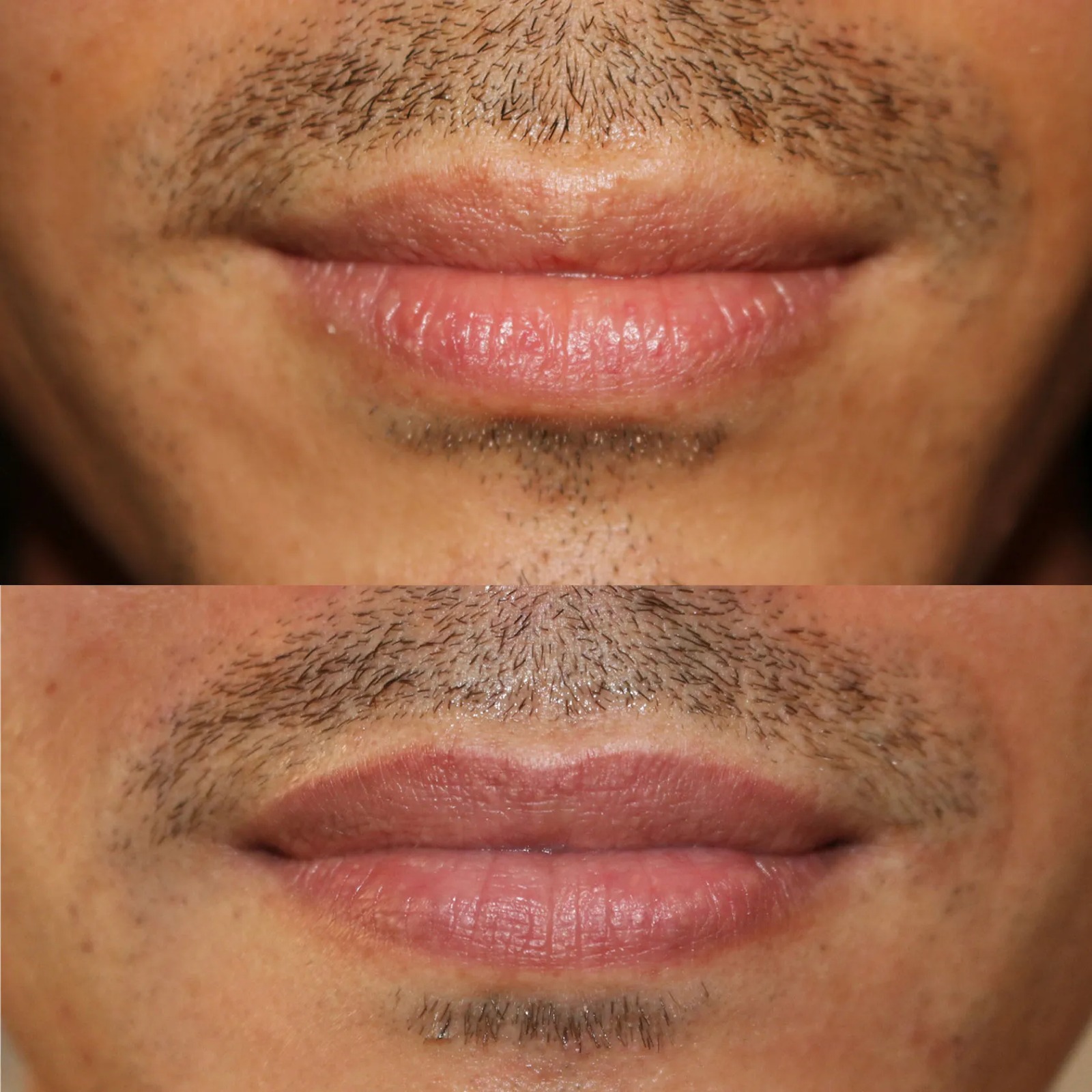 Diện mạo môi sẽ được thay đổi sau liệu trình khử thâm môi nam tại Thẩm mỹ viện Ngọc Dung