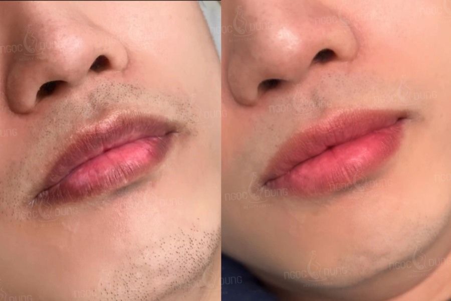 Khử thâm môi nam “vũ khí” tăng điểm phong độ, lấy lại tự tin