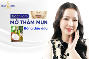 Dầu dừa có trị thâm mụn không? Bật mí các cách trị mụn và vết thâm bằng dầu dừa