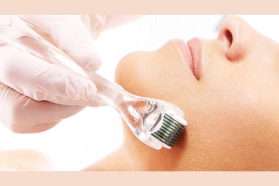 Lăn kim được đánh giá là giải pháp trị thâm mụn hiệu quả hiện nay