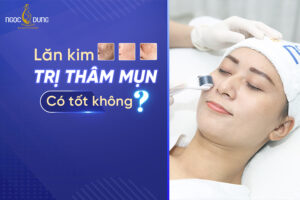 Review lăn kim trị thâm mụn có tốt không?
