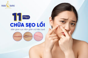 mẹo chữa sẹo lồi dân gian