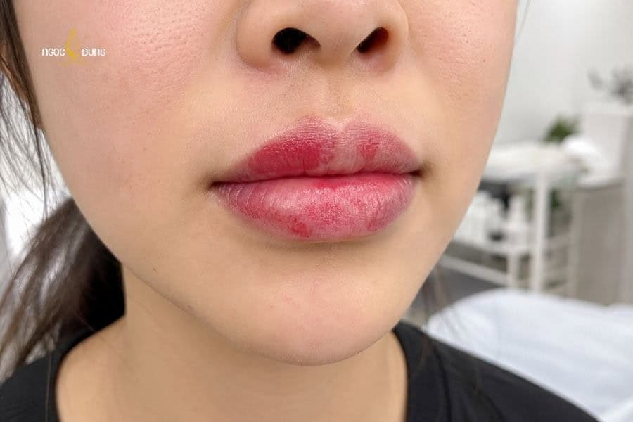 Xăm môi có hại không? Tác hại khi thực hiện sai cách 11 Xăm môi tại cơ sở không uy tín có thể làm màu môi bị loang lỗ