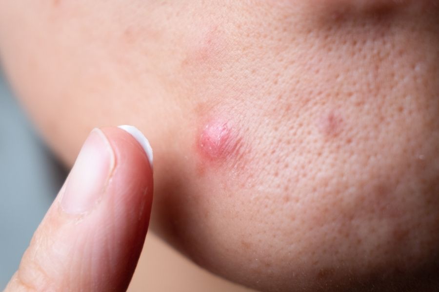 Mụn bọc không nhân thường có màu đỏ hoặc hồng, nhưng không có cồi lộ ra