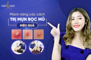 Mụn bọc có mủ là gì? Tổng hợp các cách trị mụn bọc mụn mủ hiệu quả