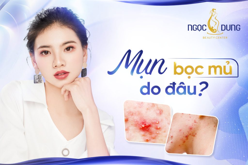 Mụn bọc mủ hình thành do đâu