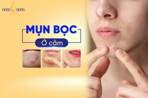Lý do bị mụn bọc ở cằm là gì?
