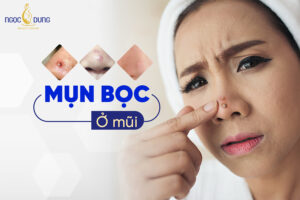 Vì sao lại bị mụn bọc ở mũi?