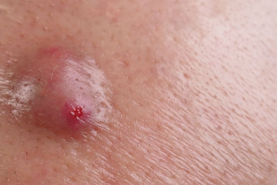 Mụn đinh râu thường xuất hiện do nhiễm trùng từ vết xước nhỏ khi cạo râu, nặn mụn sai cách