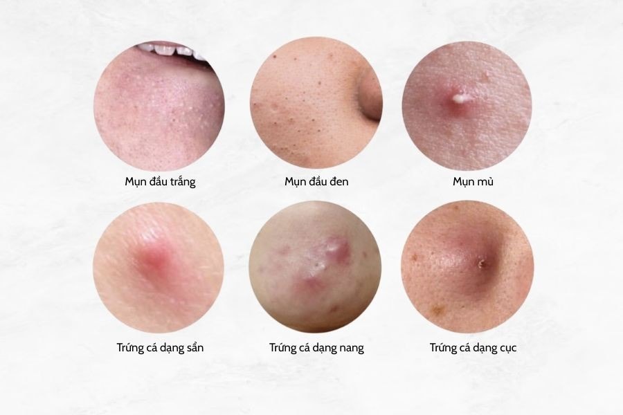 Mụn thường là nguyên nhân chính gây tăng sắc tố sau viêm
