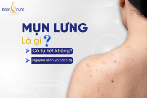 Mụn lưng là gì? Có tự hết không?