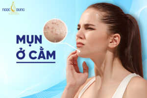 Bị nổi mụn ở cằm là bệnh gì?