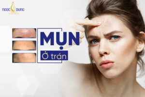 Lý do bị nổi mụn ở trán là gì?