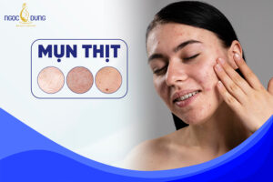 Mụn thịt có giống với mụn cóc hay không?