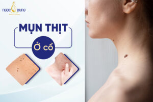 Mụn thịt ở cổ là bệnh gì?