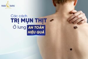 Mụn thịt thừa ở lưng - Nỗi ám ảnh của phái đẹp 