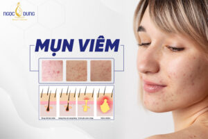 Mụn viêm có điều trị hết được không?