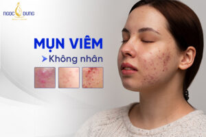 Điều trị mụn viêm không nhân có dễ không?