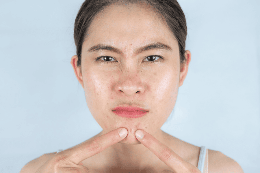 Nặn mụn sai cách sẽ đẩy vi khuẩn vào sâu hạ bì và để lại sẹo