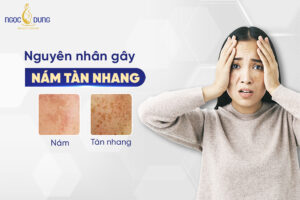 Tìm hiểu các nguyên nhân gây nám tàn nhang ở phụ nữ