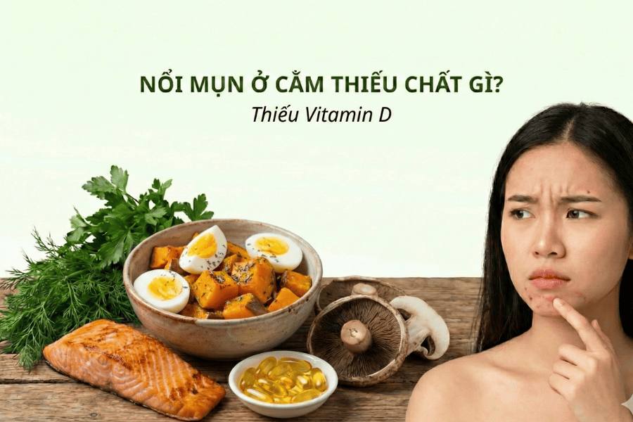 Nổi mụn ở cằm: Nguyên nhân và cách trị hiệu quả nhất hiện nay 11 Thiếu vitamin D làm suy giảm đề kháng khiến mụn cằm dễ sưng đỏ.