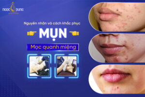 Nguyên nhân mụn mọc quanh miệng và cách điều trị hiệu quả
