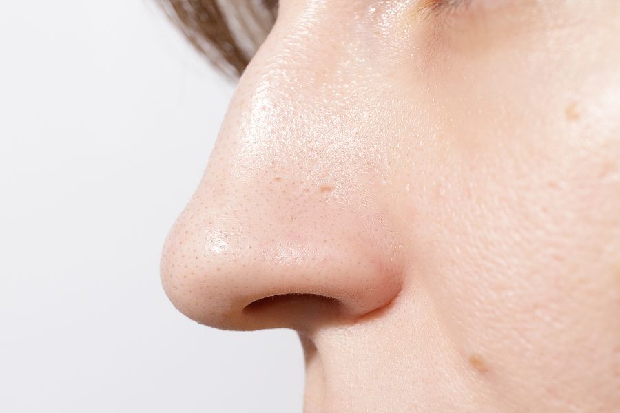 Sẹo rỗ ở mũi không thể tự khỏi bởi đây là một dạng tổn thương vĩnh viễn và nằm sâu dưới da
