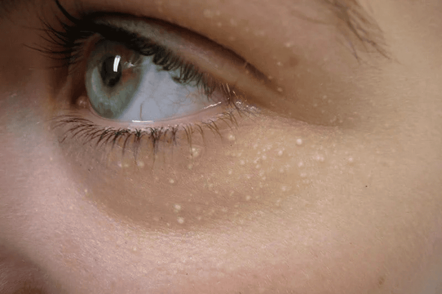 Mụn thịt là dạng tổn thương lành tính liên quan đến sự tích tụ keratin hoặc tăng sinh mô