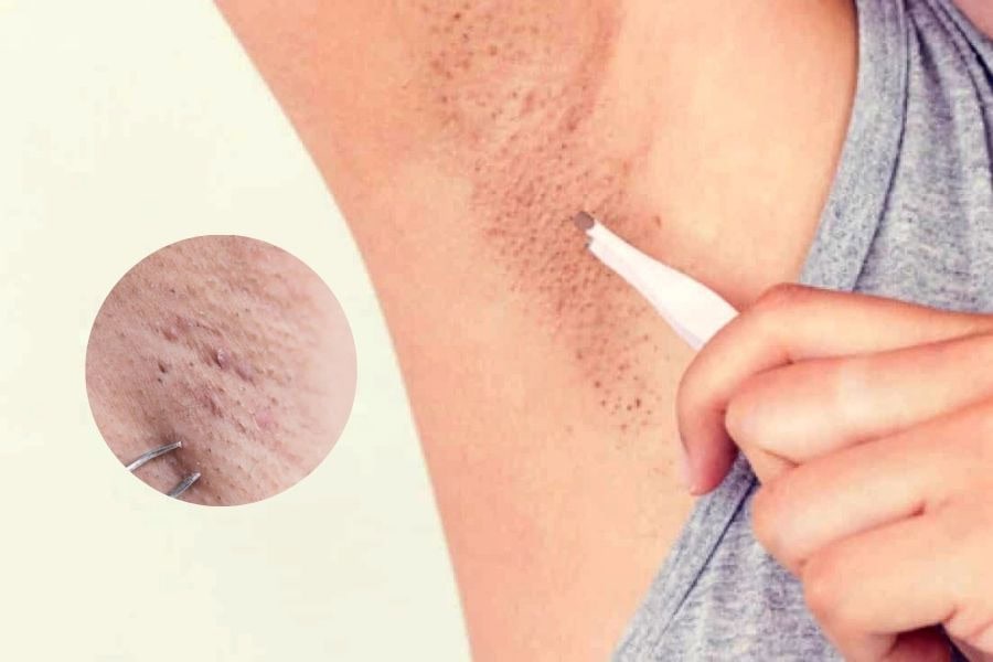 Có nên nhổ lông nách ở tuổi dậy thì không? Một số lưu ý 6 Nhíp nhổ không được sát trùng hoặc bị rỉ sét sẽ làm viêm nhiễm vùng nách