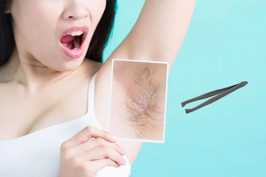 Có nên nhổ lông nách ở tuổi dậy thì không? Một số lưu ý 5 Việc nhổ lông liên tục khiến nang lông bị kích thích, lông mọc lại cứng và đậm màu hơn