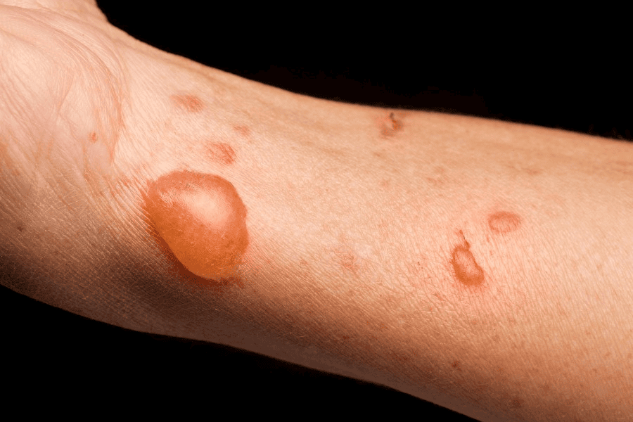 Những nguyên nhân khiến vết bỏng dễ hình thành sẹo dai dẳng