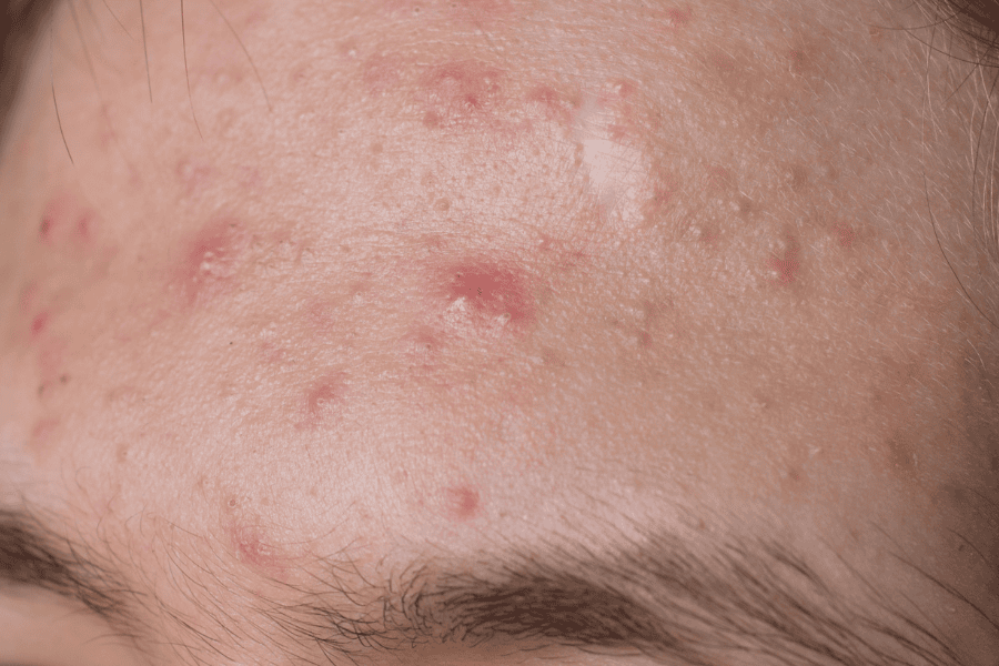 Những tác dụng phụ có thể gặp khi lạm dụng chanh để trị thâm mụn 