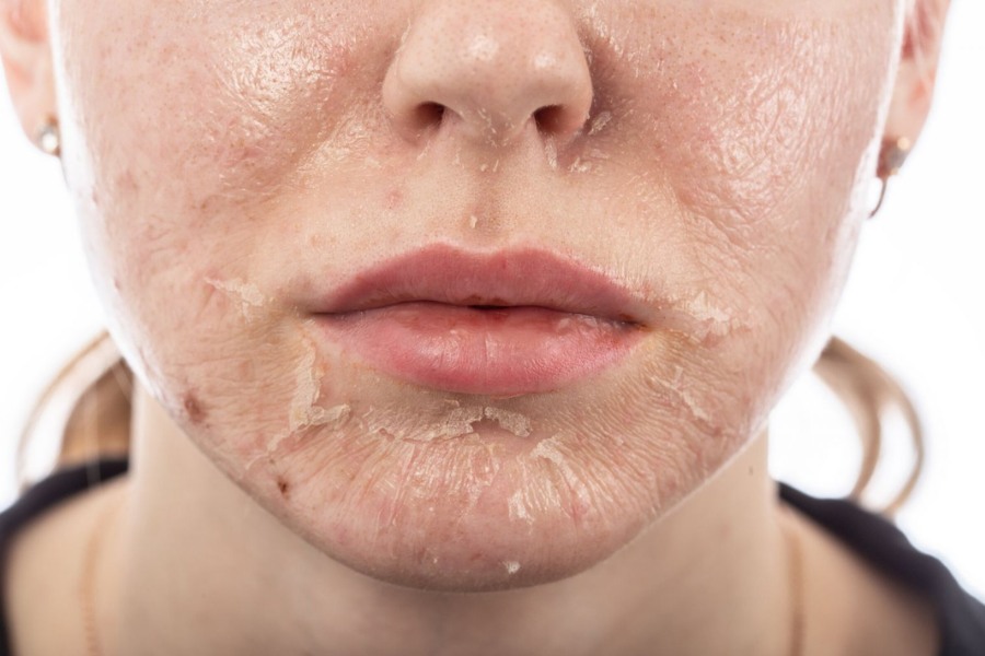 Peel da cải thiện 70-90% sắc tố da mặt sau bong