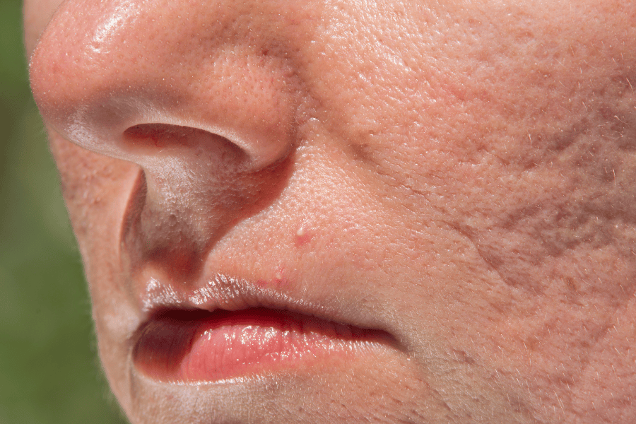 Phân biệt đúng loại sẹo để có phương pháp điều trị phù hợp