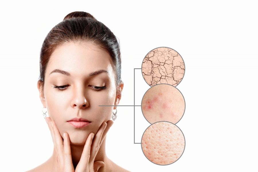 Cách xác định da mặt hỗn hợp giúp bạn tìm được phương pháp chăm sóc hiệu quả