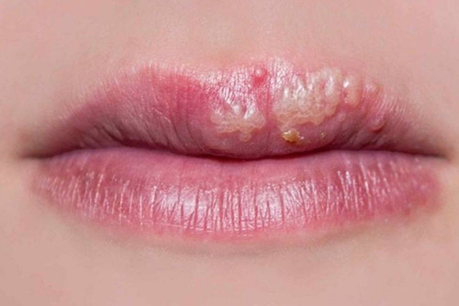 Mụn nước ở môi thường mang đến cảm giác đau rát và khó chịu