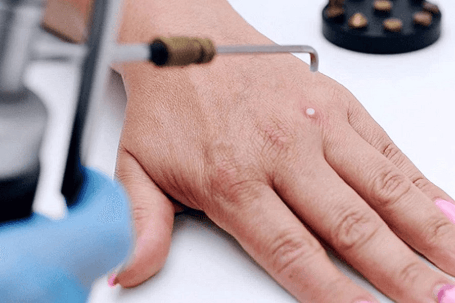 Cách điều trị sẹo phì đại an toàn, hiệu quả và thẩm mỹ 4 Phương pháp áp lạnh giúp phá hủy tế bào sẹo hiệu quả