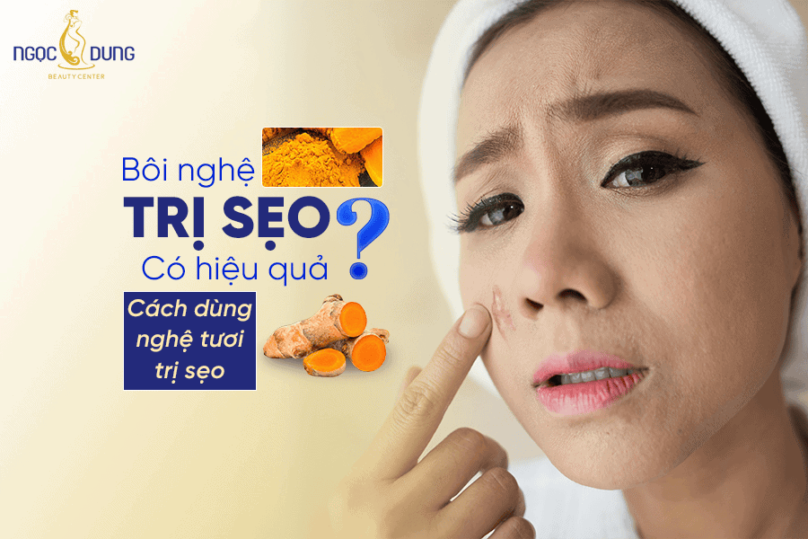 Phương pháp bôi nghệ trị sẹo hiệu quả và hạn chế để lại thâm 