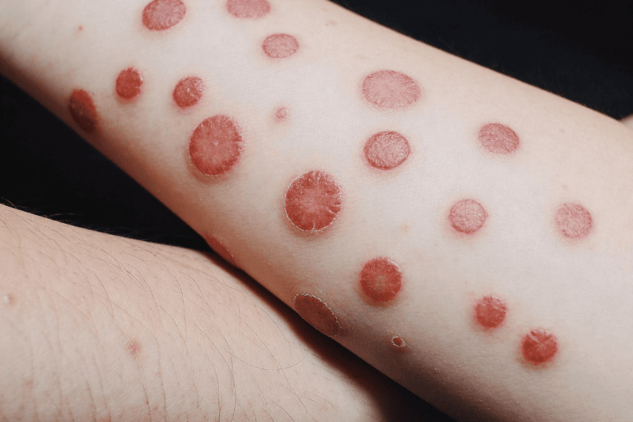 Chăm sóc không đúng cách khiến vết tích đậm màu và lồi hơn