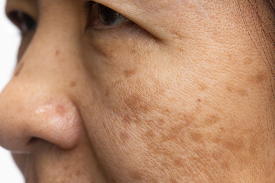 Nám, tàn nhang là tình trạng tăng sắc tố da thường gặp ở phụ nữ 