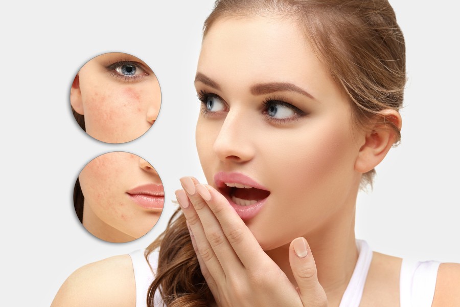 Sẹo mụn: Phân loại và cách trị sẹo mụn giúp da láng mịn 9 seo do mun
